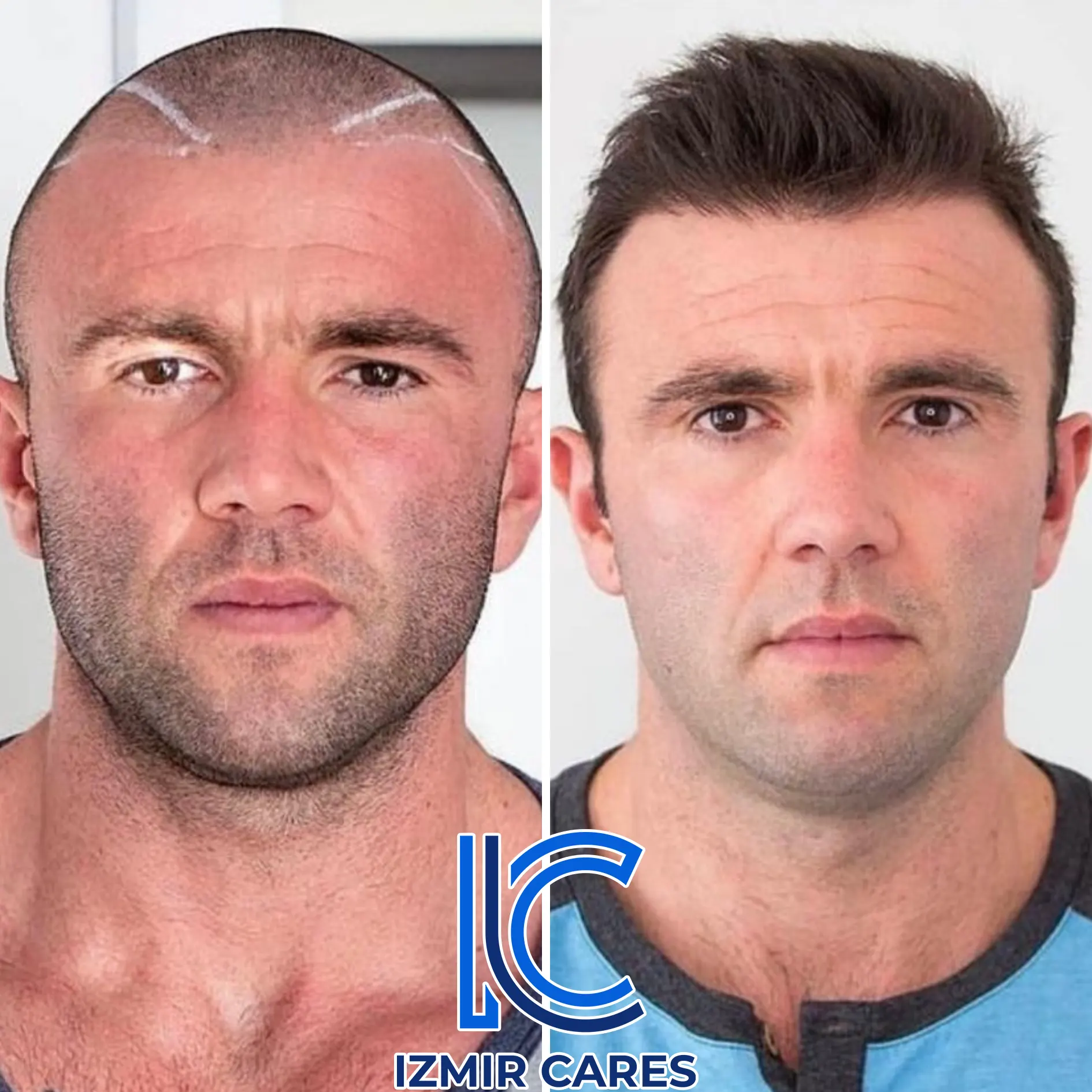 hair transplant turkey